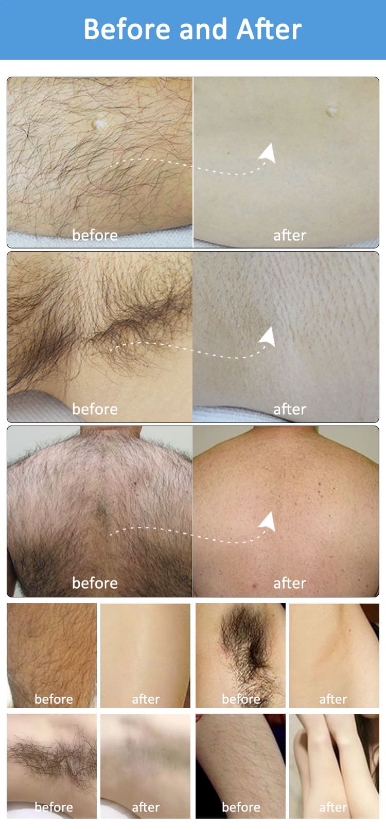 удаление волос до и после